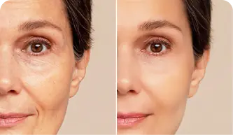 Remove skin blemishes from an image